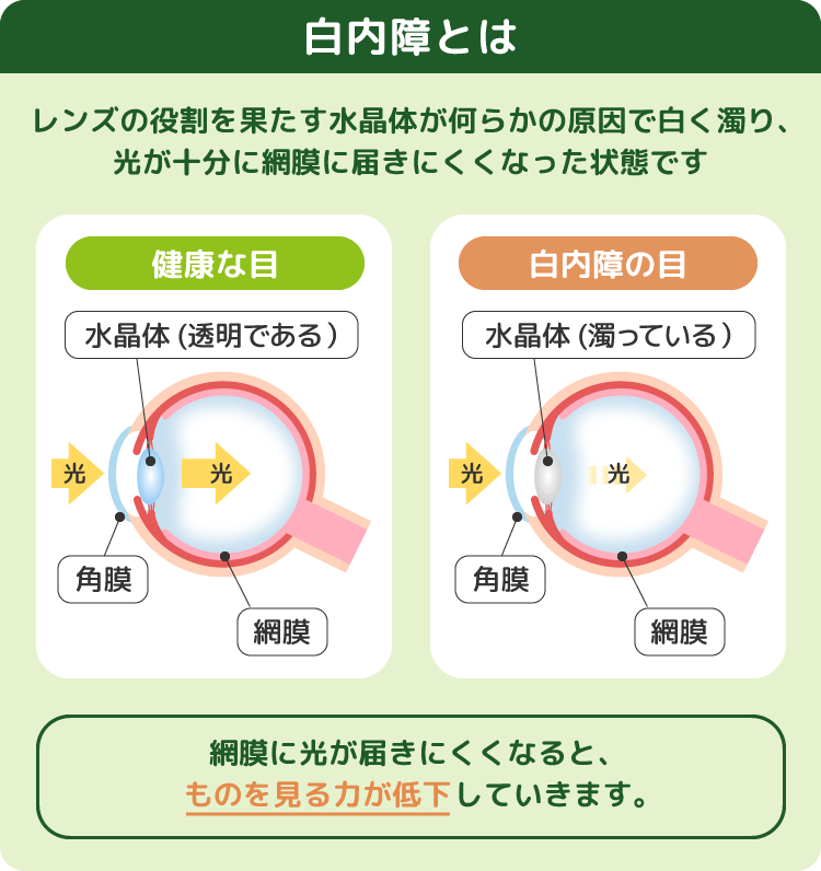 白内障とはレンズの役割を果たす水晶体が何らかの原因で白く濁り、光が十分に網膜に届きにくくなった状態です